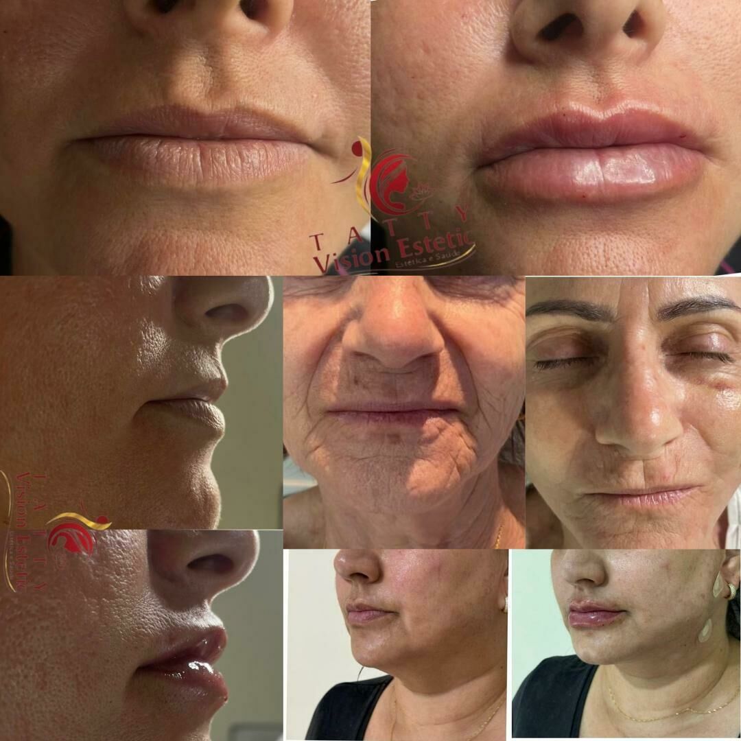 Imagem de compartilhamento para o artigo Clínica Vision Estetic tem descontos imperdíveis de botox facial, preenchimento labial e outros para ficar radiante nas festas de fim de ano da MS Todo dia